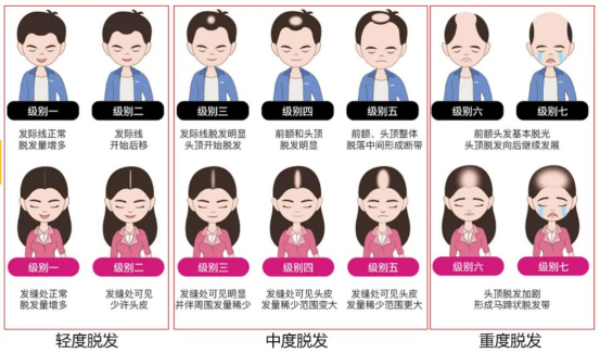 脱发