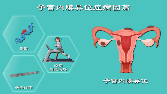子宫内膜异位症病理
