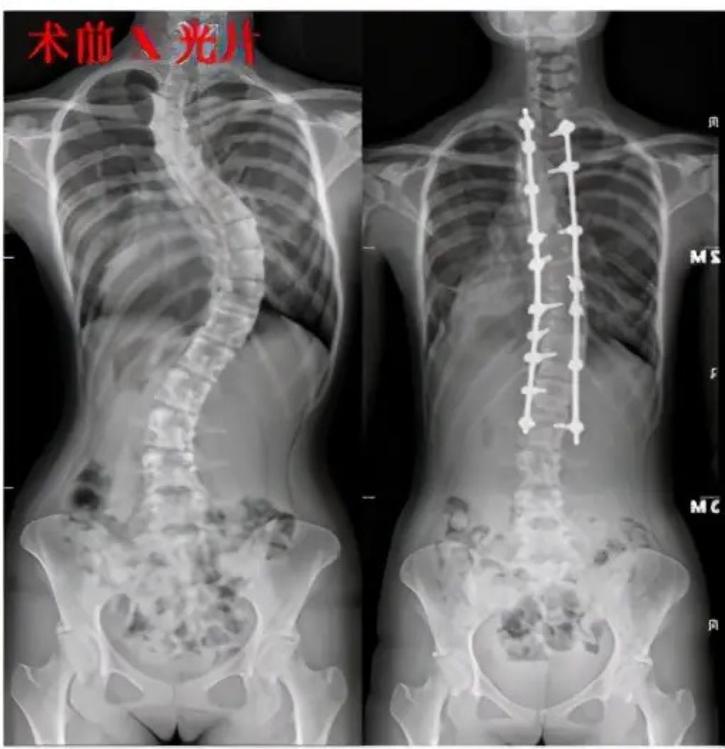 青少年特发性脊柱侧弯是什么？怎么治疗？案例对比效果【脊柱侧弯专家肖丹主任】