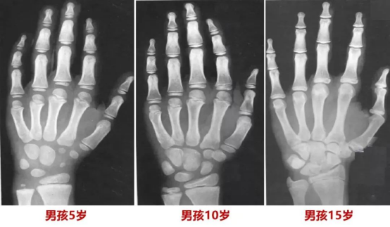 8岁到15岁的骨龄