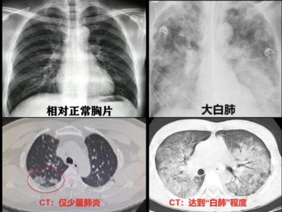 正常与白肺对比