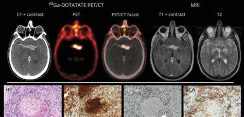 脑部PET-CT