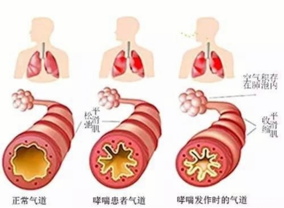 儿童支气管哮喘的疾病特征与治疗挑战