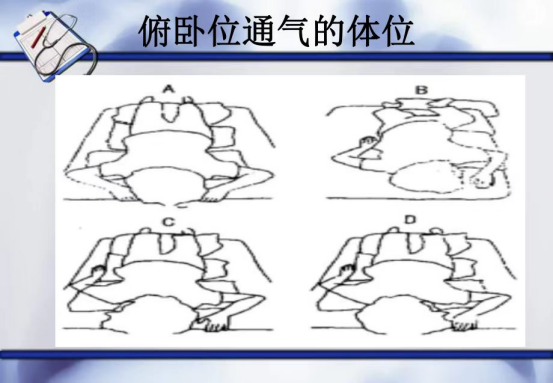俯卧位通气的体位