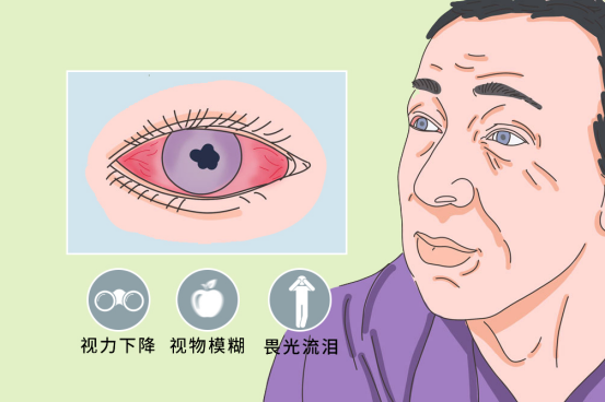 隐匿性后葡萄膜炎误诊的原因分析