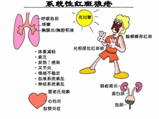 系统性红斑狼疮患者的自我管理与生活调整