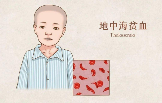β-地中海贫血患者的生存困境