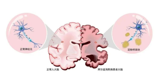 年轻血浆治疗阿尔茨海默病面临的挑战与争议