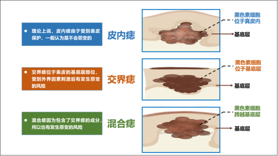 黑色素瘤治疗的革命性突破